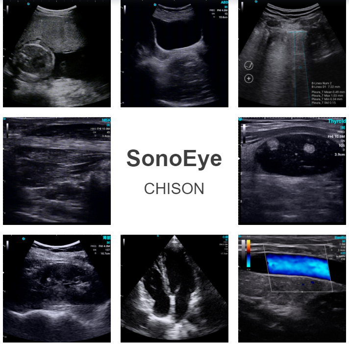 Discover A New World in General Imaging by CHISON SonoEye