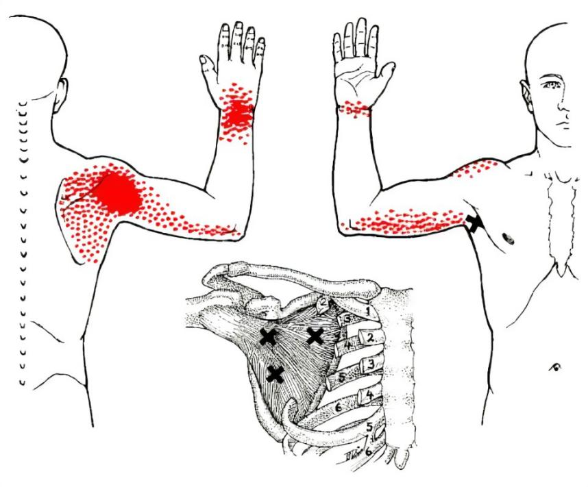 Subscapularis pain point