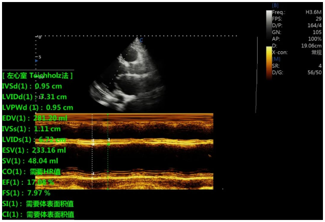 Case Report|A Case of Dilated Cardiomyopathy