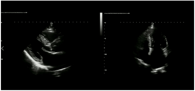 Case Report|A Case of Dilated Cardiomyopathy