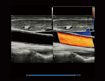 Carotid，BBC Mode