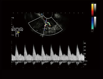 Uterus Vessel，PW Mode