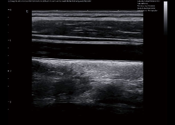 Carotid, B Mode