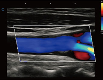 Carotid Plaque,C Mode