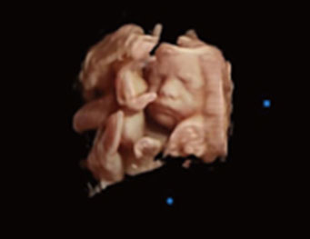 Fetal Face,Virtual HD