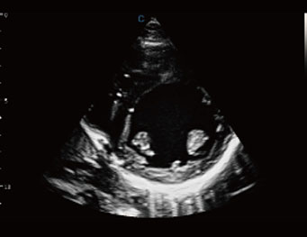 Papillary Short Axi View,B Mode