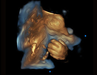 Fetal Hand,Depth View