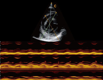 MV Short Axis View,B Mode