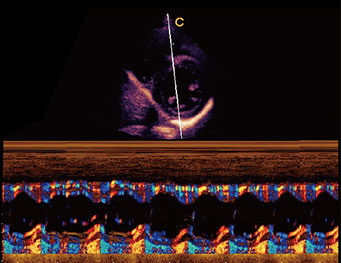 Papillary Muscle Short Axis,B Mode