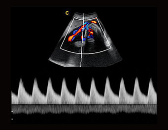 Umbilical Cord, PW Mode