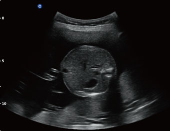 Fetal Abdomen, B Mode