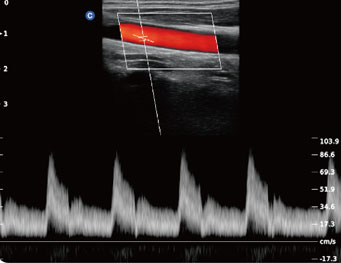 Carotid,Triplex Mode