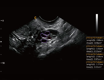 Auto Follicle, B Mode