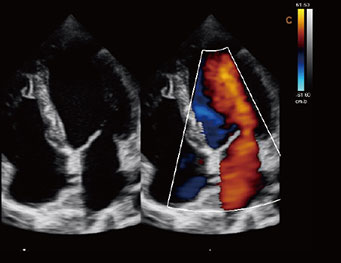 Cardiac, B BC Mode