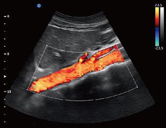 Aortic Artery, C Mode