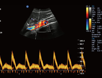 Aorta Artery, PW Mode