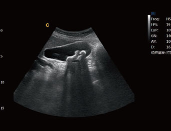Gallbladder stone, B Mode