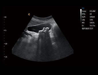 Gallbladder Stone, B Mode