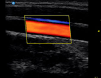 Carotid,C Mode