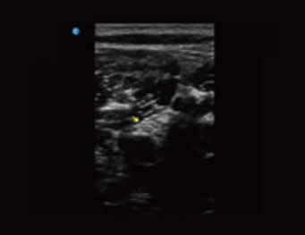 Popliteal Sciatic Nerve,B Mode