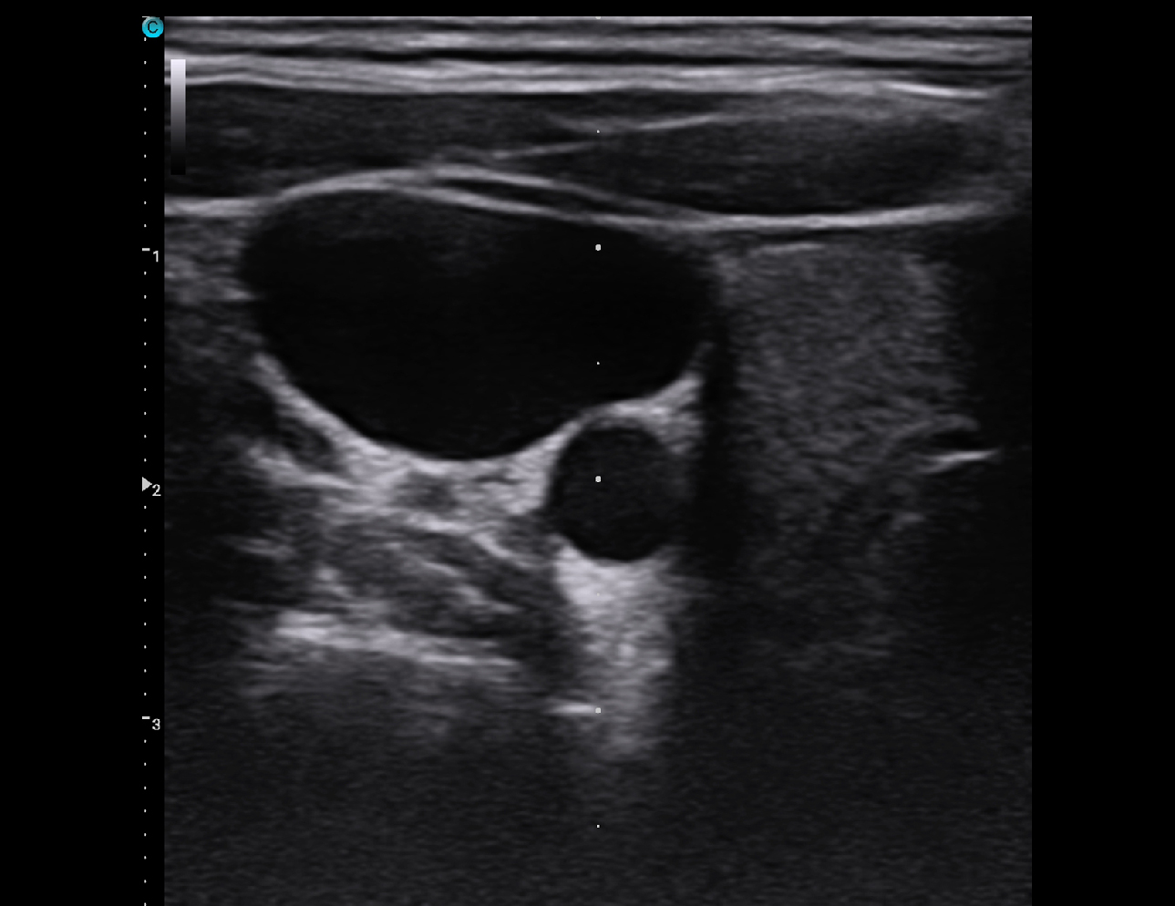 Internal-jugular, B Mode