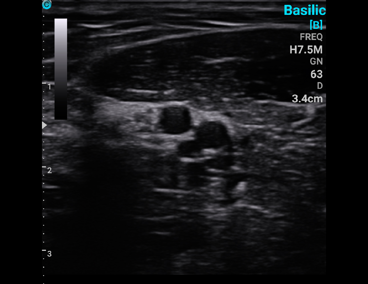 Nerve, B Mode