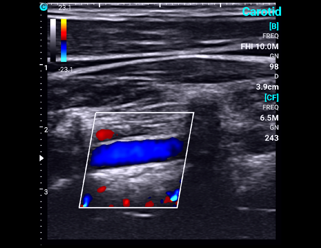 Vertebral artery, C Mode