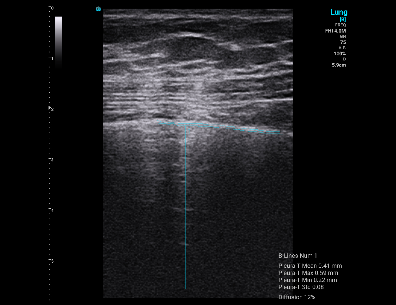 Lung, B Mode