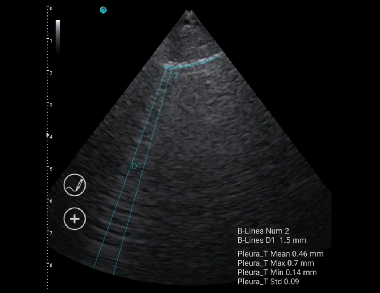 Lung, B Mode