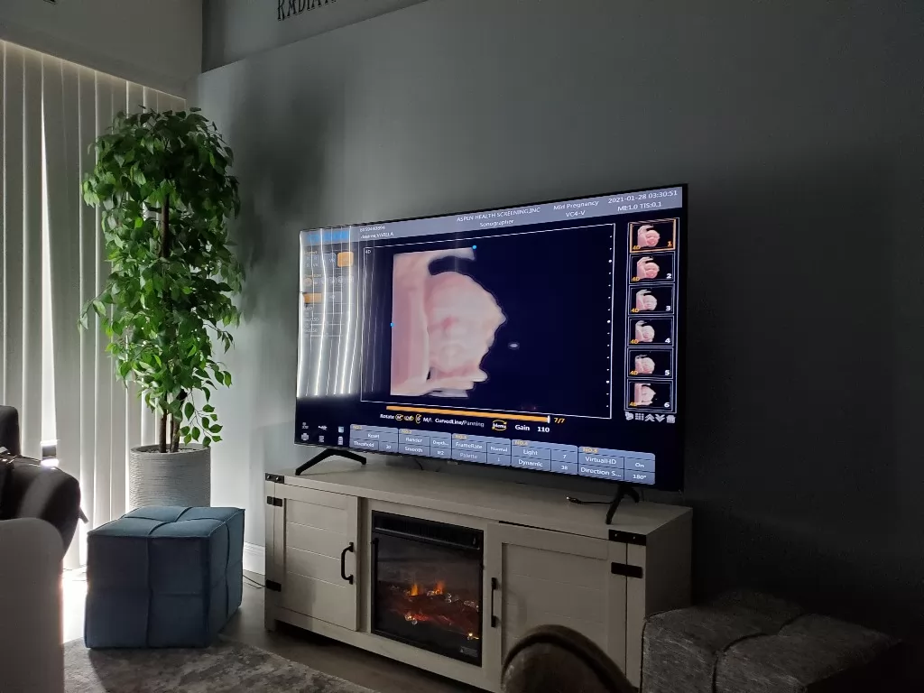  3D ultrasound can also be used to diagnose chromosomal abnormalities and congenital defects.