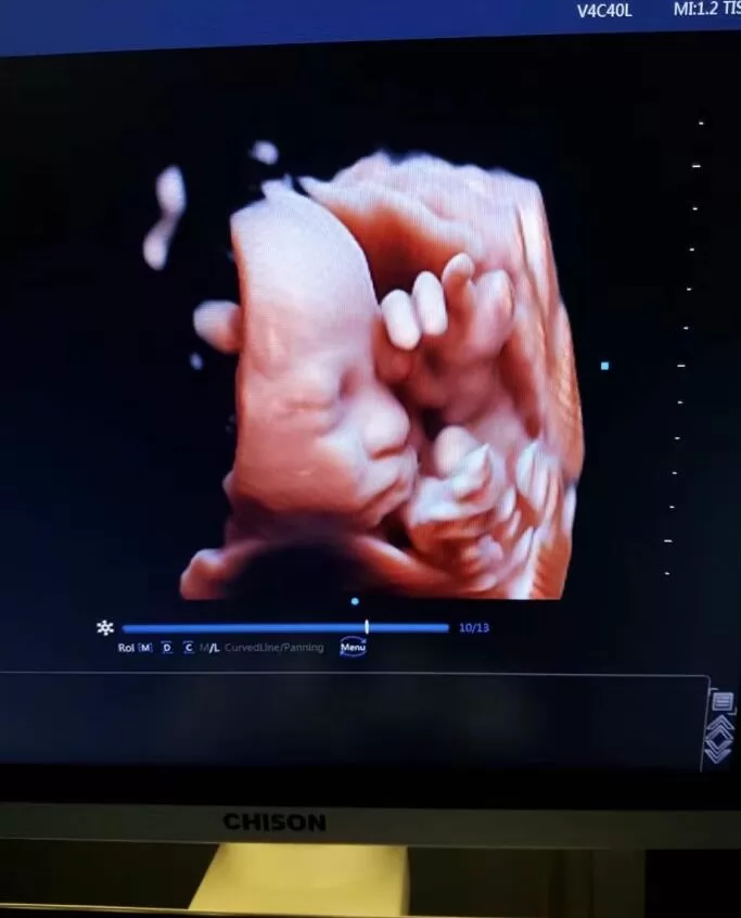 3D ultrasound machines are a powerful tool for medical professionals, offering a non-invasive and painless method of creating detailed and accurate images of internal organs and tissues.